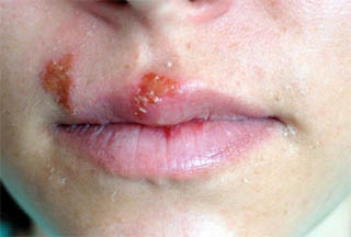 Important Herpes Symptoms That Needs To Be Known