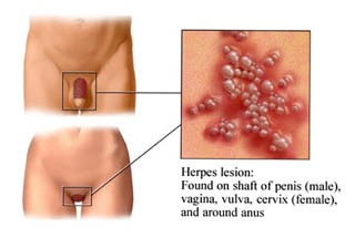 Signs of Herpes